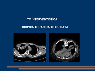 TC INTERVENTISTICA
BIOPSIA TORACICA TC GUIDATA
 