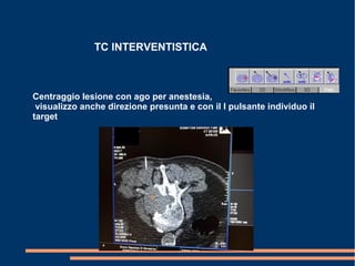 TC INTERVENTISTICA
Centraggio lesione con ago per anestesia,
visualizzo anche direzione presunta e con il I pulsante individuo il
target
 