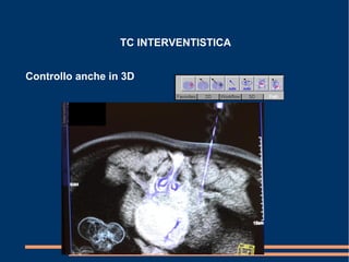 TC INTERVENTISTICA
Controllo anche in 3D
 