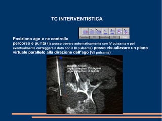 TC INTERVENTISTICA
Posiziono ago e ne controllo
percorso e punta (la posso trovare automaticamente con IV pulsante e poi
eventualmente correggere il dato con il III pulsante) posso visualizzare un piano
virtuale parallelo alla direzione dell'ago (VII pulsante)
 