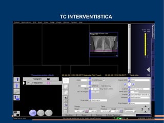 TC INTERVENTISTICA
 