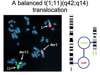 A balanced t(1;11)(q42;q14) translocation der1 der11 11 1 1 1q42 11q14 11 