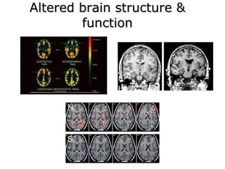 Altered brain structure & function 