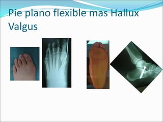 Pie plano flexible mas Hallux
Valgus
 