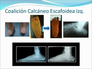 Coalición Calcáneo Escafoidea izq.
 