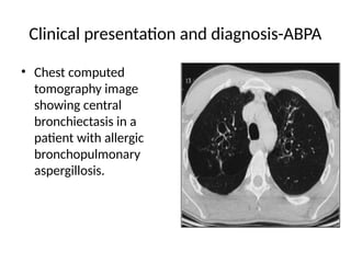 Pulmonary aspergillosis -diagnosis and management | PPTX
