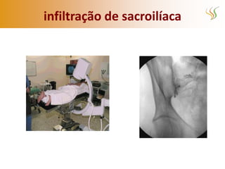 infiltração de sacroilíaca
 