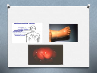 Haemophilus Influenza type B (Hib)