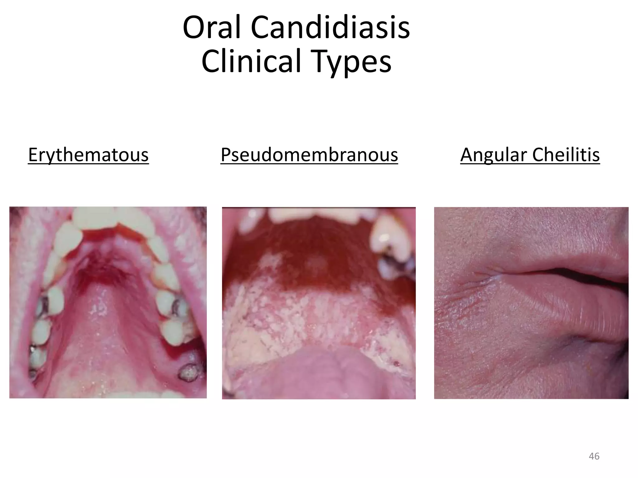 Oral Candidiasis 
Clinical Types 
Erythematous Pseudomembranous Angular Cheilitis 
46 
 
