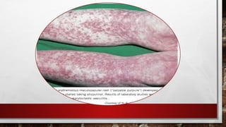 Vraylar Rash presention about Drugs Reactuion and Types of Drug reaction .pptx