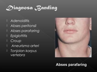    Adenoiditis
   Abses peritonsil
   Abses parafaring
   Epiglottitis
   Croup
    Aneurisma arteri
   Tonjolan korpus
    vertebra

                        Abses parafaring
 