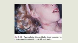 Bacterial Infections of Oral Cavity | PPTX