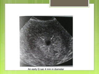 An early G sac 4 mm in diameter
 