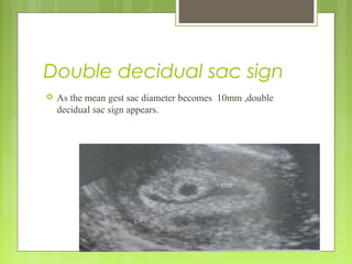 Double decidual sac sign
 As the mean gest sac diameter becomes 10mm ,double
decidual sac sign appears.
 