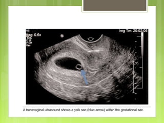 Acnormal Usg Week Usg | PPT
