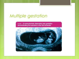 Multiple gestation
 