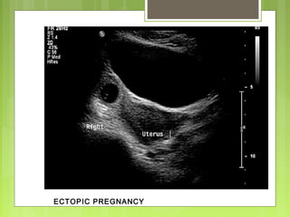 ECTOPIC PREGNANCY
 