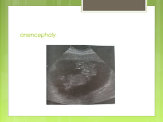 anencephaly
 