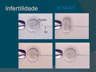 ICSI-ET

Ovócito




     Ez
 