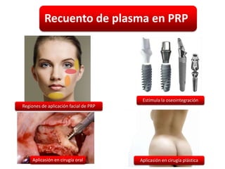 Recuento de plasma en PRP




                                        Estimula la oseointegración
Regiones de aplicación facial de PRP




     Aplicasión en cirugía oral        Aplicasión en cirugía plástica
 