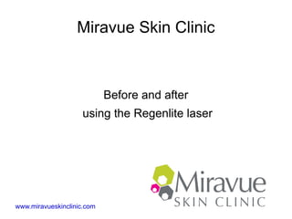 Miravue Skin Clinic



                            Before and after
                    using the Regenlite laser




www.miravueskinclinic.com
 