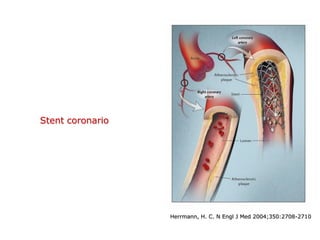 Herrmann, H. C. N Engl J Med 2004;350:2708-2710
Stent coronario
 