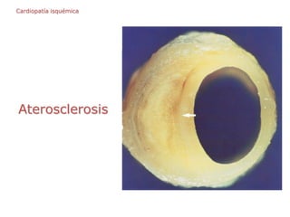 Aterosclerosis
Cardiopatía isquémica
 