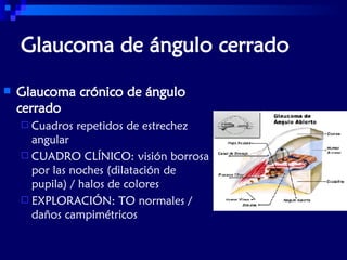 Presión Intraocular y Glaucoma | PPT