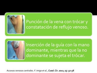 Punción de la vena con trócar y
constatación de reflujo venoso.
Inserción de la guía con la mano
dominante, mientras que la no
dominante se sujeta el trócar.
Accesos venosos centrales. F. Imigo et al., Cuad. Cir. 2011; 25: 52-58
 