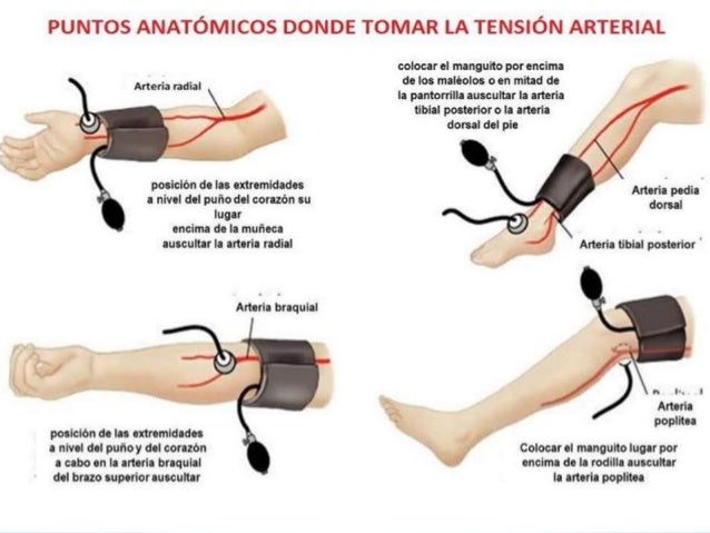 La hernia intervertebral de 4 5 vértebras
