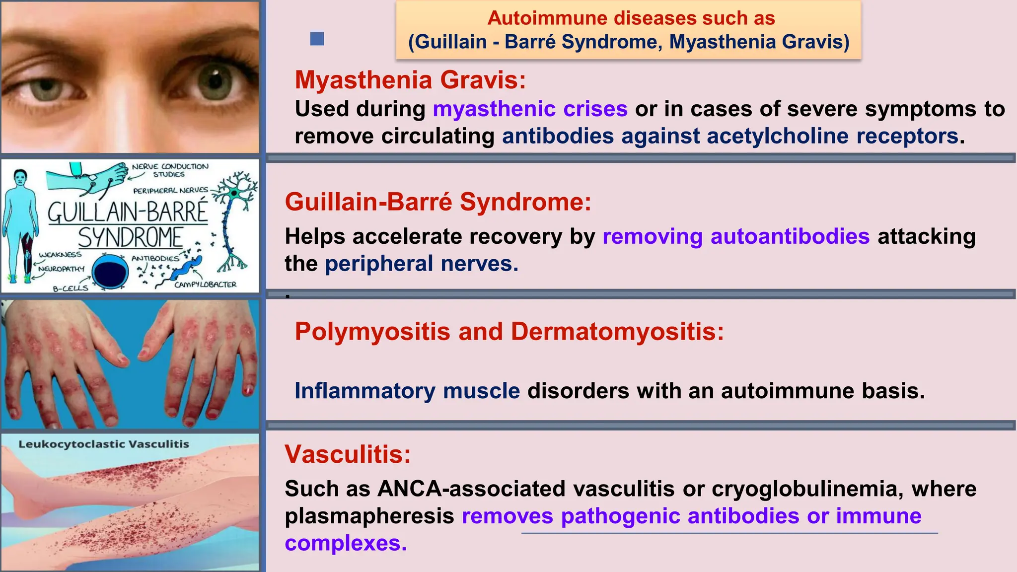Autoimmune diseases such as
(Guillain - Barré Syndrome, Myasthenia Gravis)
Myasthenia Gravis:
Used during myasthenic crises or in cases of severe symptoms to
remove circulating antibodies against acetylcholine receptors.
Guillain-Barré Syndrome:
Helps accelerate recovery by removing autoantibodies attacking
the peripheral nerves.
.
Polymyositis and Dermatomyositis:
Inflammatory muscle disorders with an autoimmune basis.
Vasculitis:
Such as ANCA-associated vasculitis or cryoglobulinemia, where
plasmapheresis removes pathogenic antibodies or immune
complexes.
 