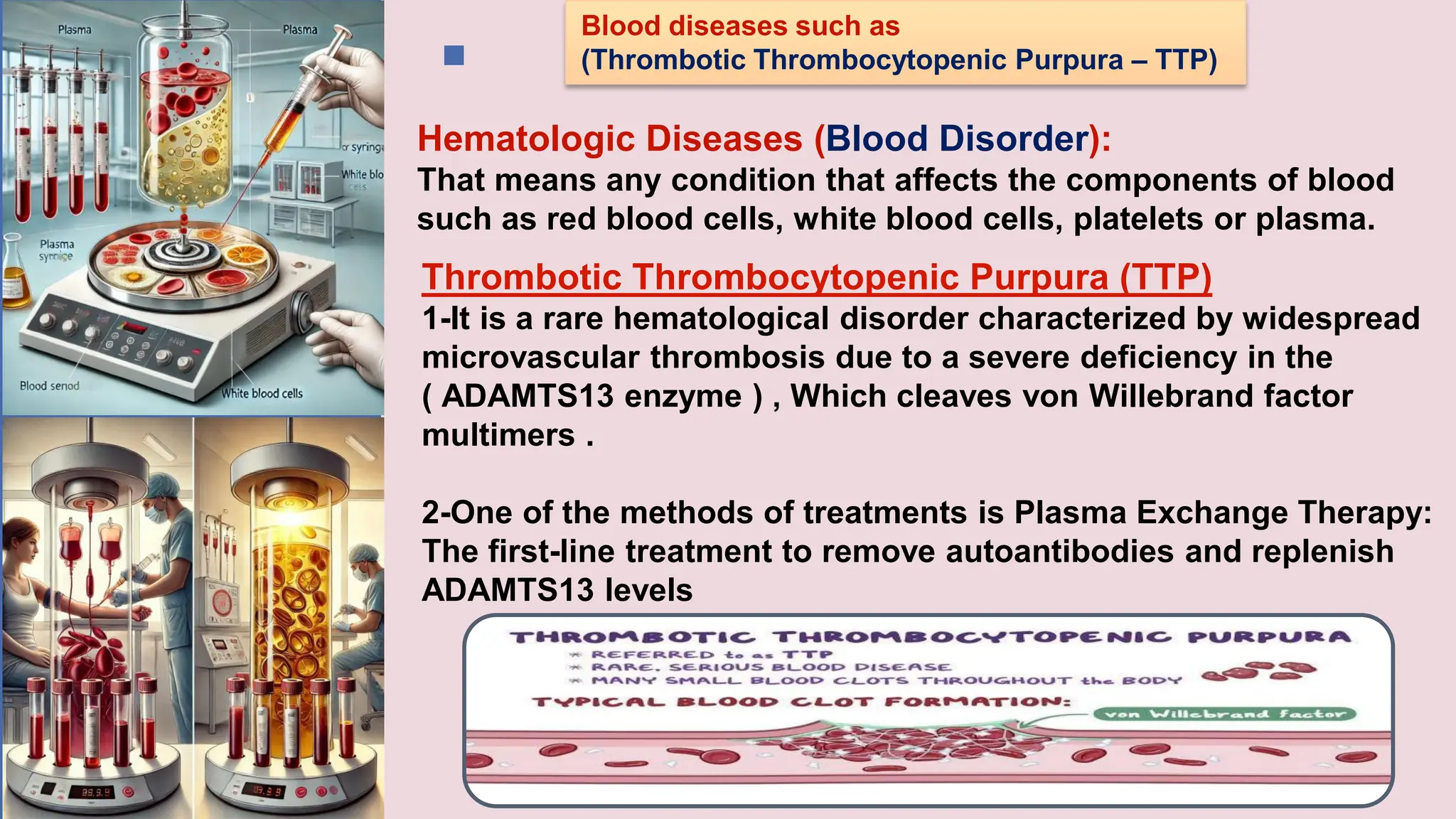 Hematologic Diseases (Blood Disorder):
That means any condition that affects the components of blood
such as red blood cells, white blood cells, platelets or plasma.
Thrombotic Thrombocytopenic Purpura (TTP)
1-It is a rare hematological disorder characterized by widespread
microvascular thrombosis due to a severe deficiency in the
( ADAMTS13 enzyme ) , Which cleaves von Willebrand factor
multimers .
2-One of the methods of treatments is Plasma Exchange Therapy:
The first-line treatment to remove autoantibodies and replenish
ADAMTS13 levels
Blood diseases such as
(Thrombotic Thrombocytopenic Purpura – TTP)
 