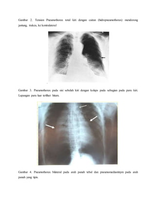 Gambar 2. Tension Pneumothorax total kiri dengan cairan (hidropneumothorax) mendorong
jantung, trakea, ke kontralateral
.
Gambar 3. Pneumothorax pada sisi sebelah kiri dengan kolaps pada sebagian pada paru kiri.
Lapangan paru luar terlihat hitam.
Gambar 4. Pneumothorax bilateral pada arah panah tebal dan pneumomediastinym pada arah
panah yang tipis.
 