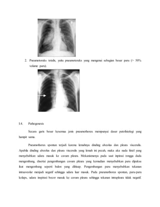 2. Pneumotoraks totalis, yaitu pneumotoraks yang mengenai sebagian besar paru (> 50%
volume paru).
I.4. Pathogenesis
Secara garis besar kesemua jenis pneumothorax mempunyai dasar patofisiologi yang
hampir sama.
Pneumothorax spontan terjadi karena lemahnya dinding alveolus dan pleura visceralis.
Apabila dinding alveolus dan pleura visceralis yang lemah ini pecah, maka aka nada fistel yang
menyebabkan udara masuk ke cavum pleura. Mekanismenya pada saat inpirasi rongga dada
mengembang, disertai pengembangan cavum pleura yang kemudian menyebabkan paru dipaksa
ikut mengembang seperti balon yang dihisap. Pengembangan paru menyebabkan tekanan
intraaveolar menjadi negatif sehingga udara luar masuk. Pada pneumothorax spontan, paru-paru
kolaps, udara inspirasi bocor masuk ke cavum pleura sehingga tekanan intrapleura tidak negatif.
 