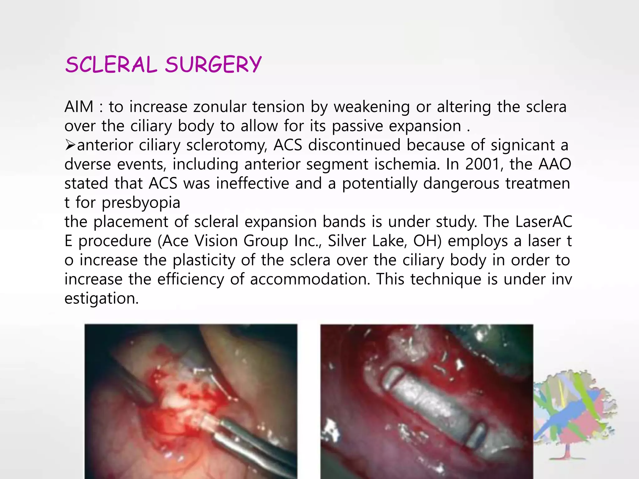 SCLERAL SURGERY
AIM : to increase zonular tension by weakening or altering the sclera
over the ciliary body to allow for its passive expansion .
anterior ciliary sclerotomy, ACS discontinued because of signicant a
dverse events, including anterior segment ischemia. In 2001, the AAO
stated that ACS was ineffective and a potentially dangerous treatmen
t for presbyopia
the placement of scleral expansion bands is under study. The LaserAC
E procedure (Ace Vision Group Inc., Silver Lake, OH) employs a laser t
o increase the plasticity of the sclera over the ciliary body in order to
increase the efficiency of accommodation. This technique is under inv
estigation.
 