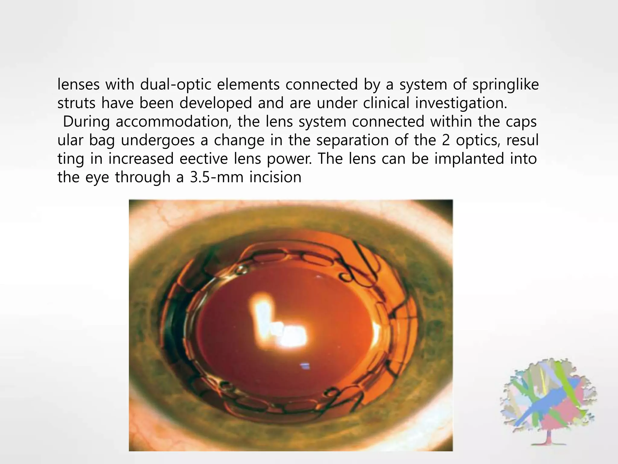 lenses with dual-optic elements connected by a system of springlike
struts have been developed and are under clinical investigation.
During accommodation, the lens system connected within the caps
ular bag undergoes a change in the separation of the 2 optics, resul
ting in increased eective lens power. The lens can be implanted into
the eye through a 3.5-mm incision
 