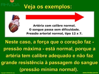 Artéria com calibre normal. O sangue passa sem dificuldade. Pressão arterial normal, tipo 12 x 7. Veja os exemplos: Neste caso, a força que o coração faz - pressão máxima - está normal, porque a artéria tem calibre adequado e não faz grande resistência à passagem do sangue (pressão mínima normal).  