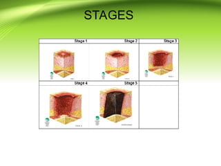 pressure ulcer prevention power point presentation | PPT