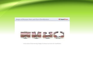 pressure ulcer prevention power point presentation | PPT