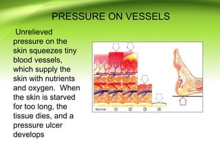 pressure ulcer prevention power point presentation | PPT