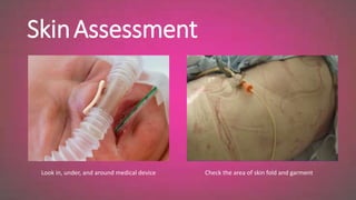 Splint Skin Check say no to pressure injury(pathophysiology, prevention, management) | PPTX