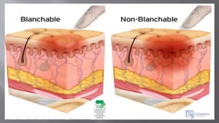 PRESSURE INJURY PREVENTION & MANAGEMENT.pptx