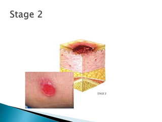 pressure sore.ppt