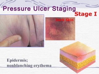 Pressure Ulcer Staging
Stage I
Epidermis;
nonblanching erythema
Dark Skin
 