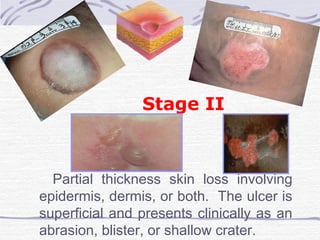 Partial thickness skin loss involving
epidermis, dermis, or both. The ulcer is
superficial and presents clinically as an
abrasion, blister, or shallow crater.
Stage II
 