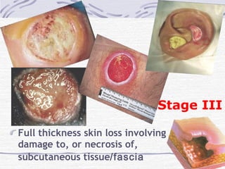 Full thickness skin loss involving
damage to, or necrosis of,
subcutaneous tissue/fascia
Stage III
 