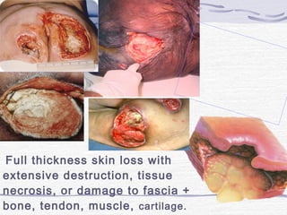 Full thickness skin loss with
extensive destruction, tissue
necrosis, or damage to fascia +
bone, tendon, muscle, cartilage.
 