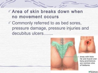 Area of skin breaks down when
no movement occurs
Commonly referred to as bed sores,
pressure damage, pressure injuries and
decubitus ulcers........
 