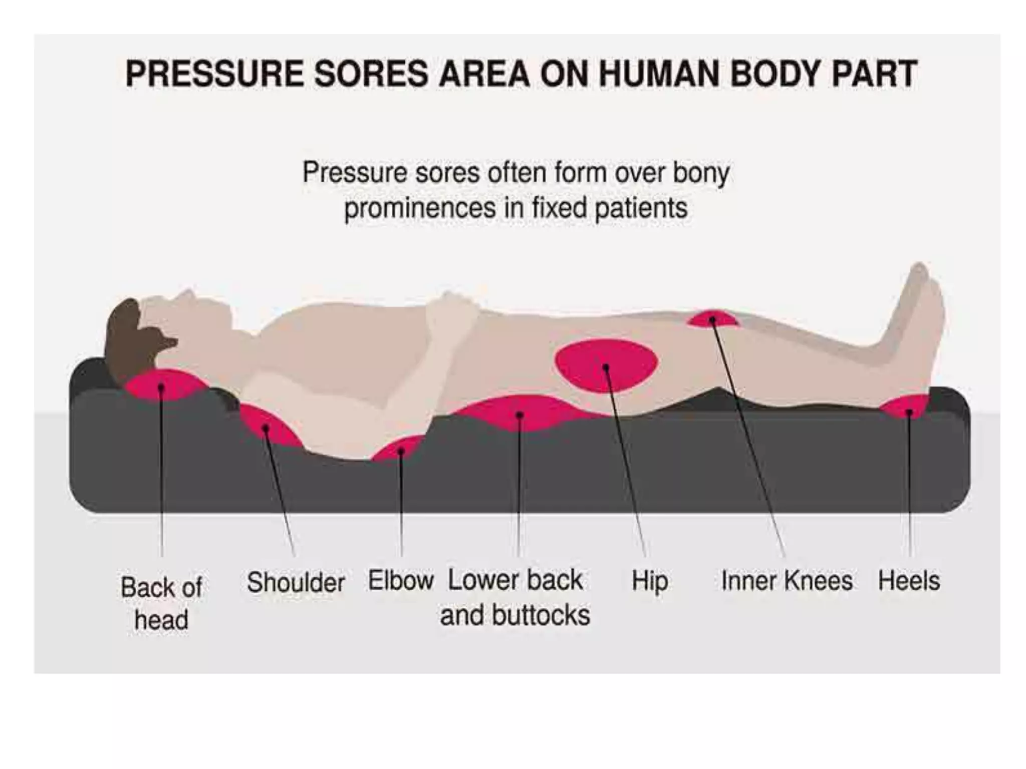 Pressure sore or bed sore or decubitus ulcer ppt | PPTX