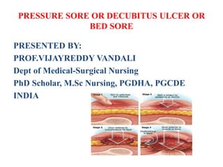PRESSURE SORE OR DECUBITUS ULCER OR
BED SORE
PRESENTED BY:
PROF.VIJAYREDDY VANDALI
Dept of Medical-Surgical Nursing
PhD Scholar, M.Sc Nursing, PGDHA, PGCDE
INDIA
 